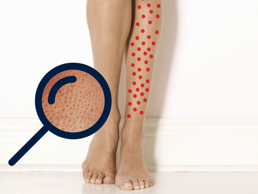 Pernas de morango: Como evita? Esfoliar a pele, hidratar, depilação definitiva, laser, luz pulsada.